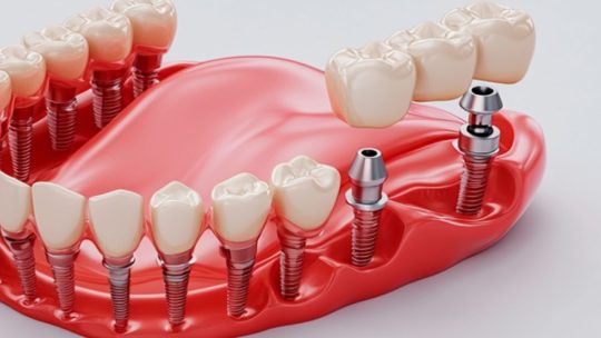 Импланты нового поколения: чем отличаются и почему служат дольше