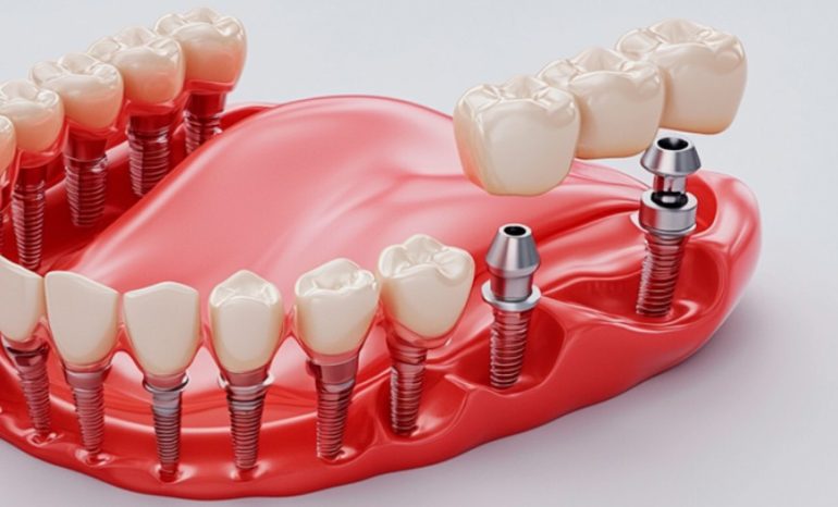 Импланты нового поколения: чем отличаются и почему служат дольше